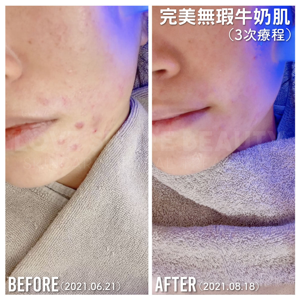 完美無瑕牛奶肌(單次)