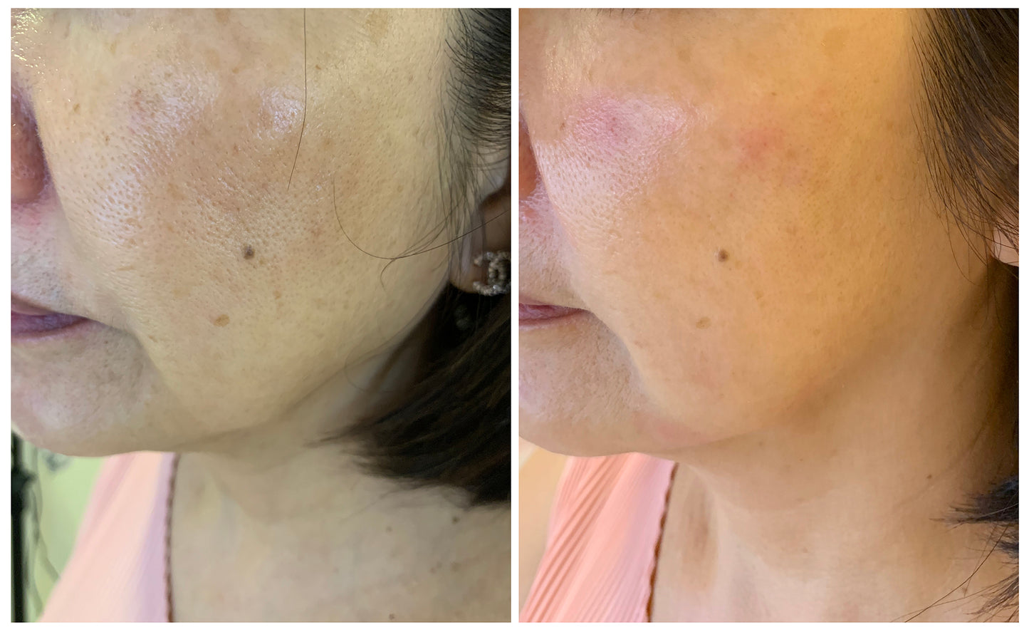 零毛孔牛奶肌(單次)